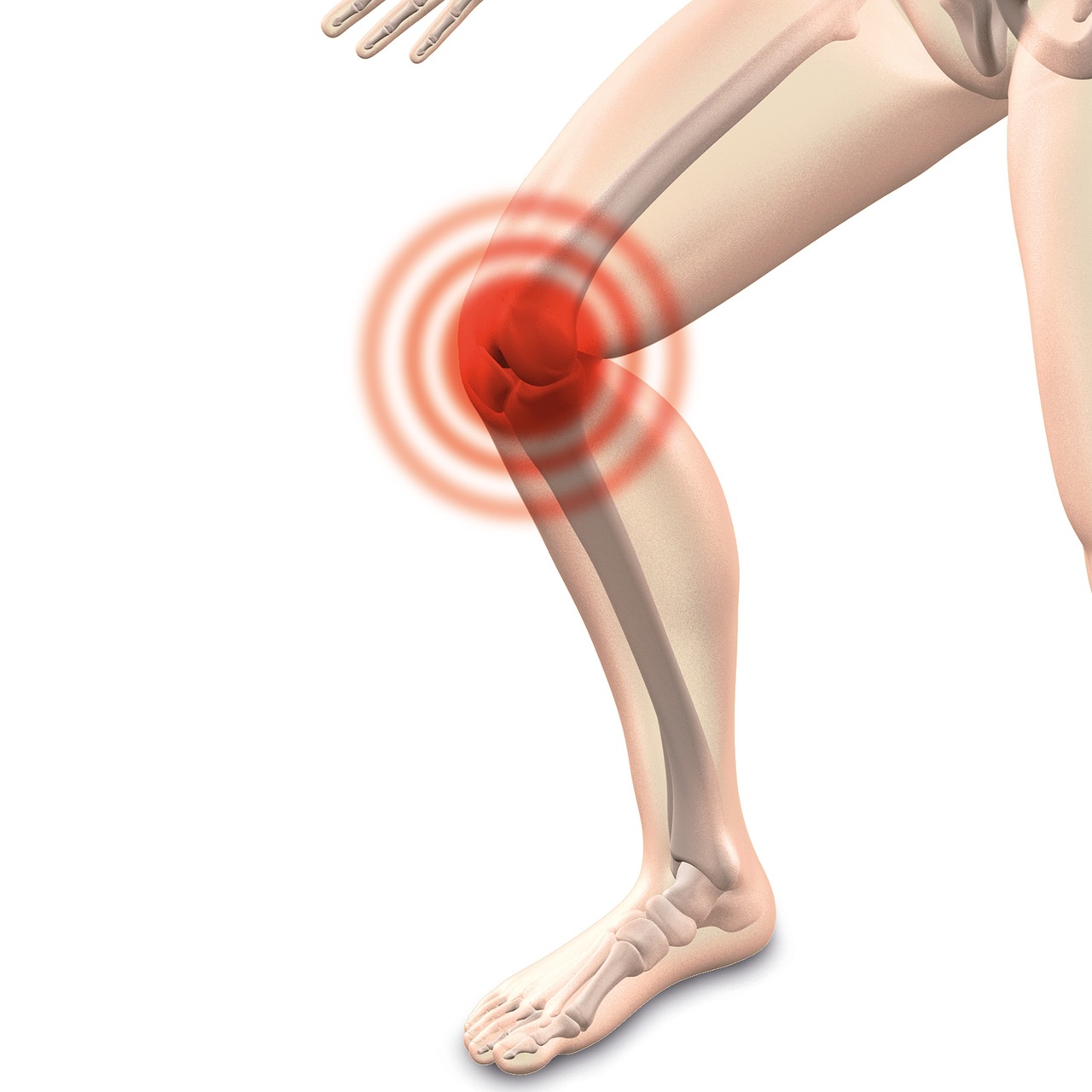 Arthrocalman, Osteoartritas, Kelio, Nemokamos Nuotraukos,  Nemokama Licenzija