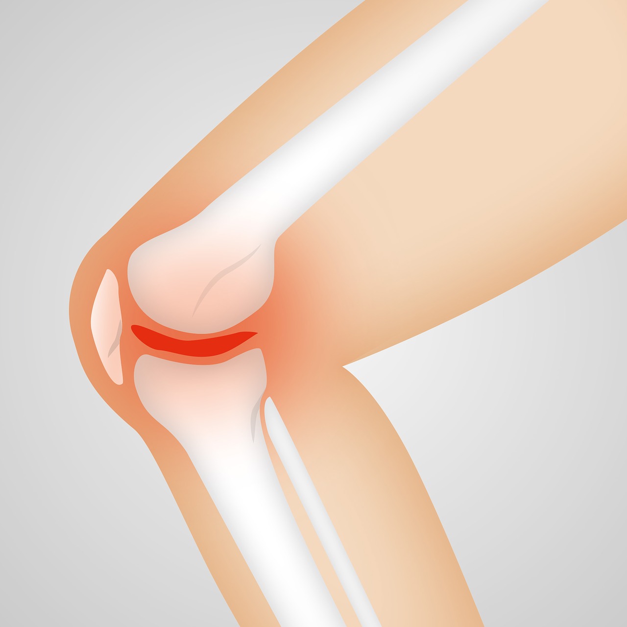 Arthrocalman, Osteoartritas, Kelio, Nemokamos Nuotraukos,  Nemokama Licenzija