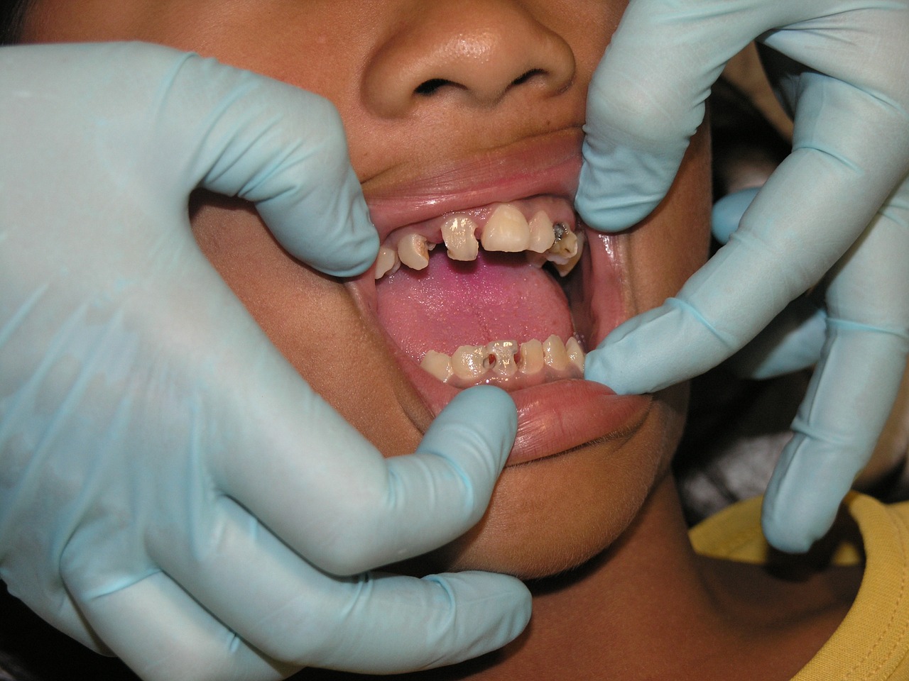 Blogi Dantys, Dantų Skausmas, Dantų Gydymas, Nemokamos Nuotraukos,  Nemokama Licenzija
