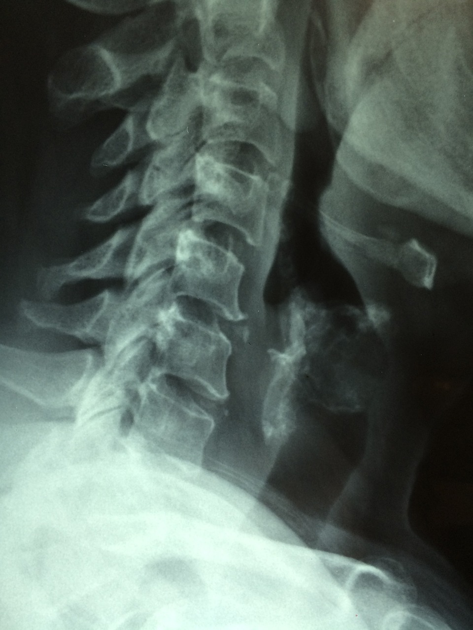 Vėžys, Rentgeno Spinduliai, Nuskaityti, Liga, Egzaminas, Onkologija, Gydytojas, Gydymas, Diagnozuoti, Ligoninė