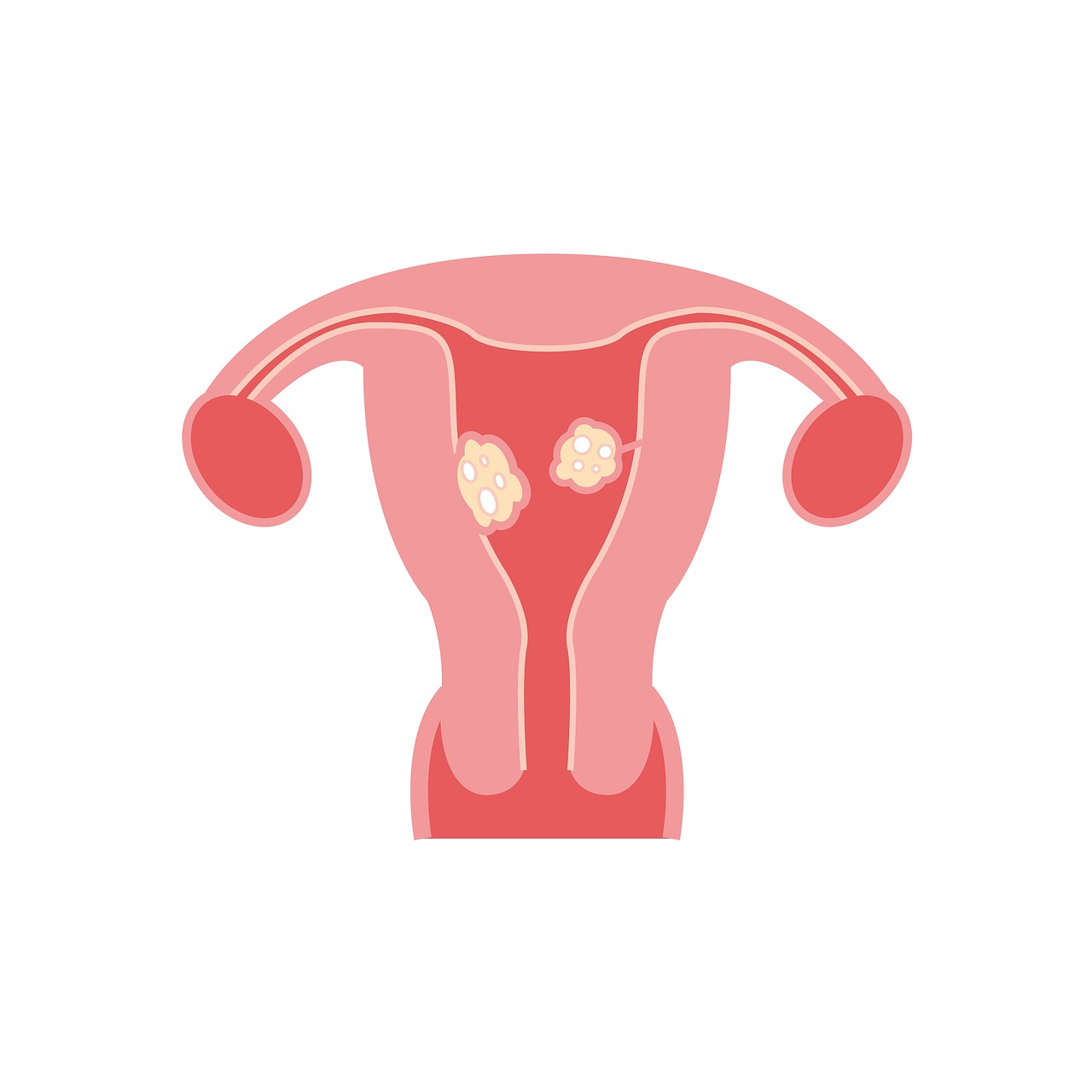 Fibroids, Fibrozės Modelis, Fibroidų Tipai, Nemokamos Nuotraukos,  Nemokama Licenzija