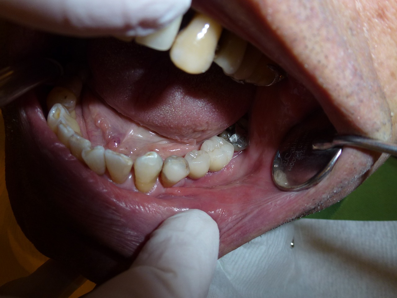 Implantas, Odontologija, Stomatologas, Dantys, Chirurgija, Nemokamos Nuotraukos,  Nemokama Licenzija