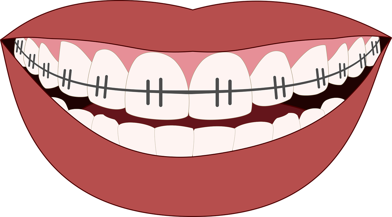 Ortodontija, Šypsena, Dantys, Stomatologas, Odontologija, Šypsosi, Dantų Burna, Prietaisas, Piktograma, Iliustracija