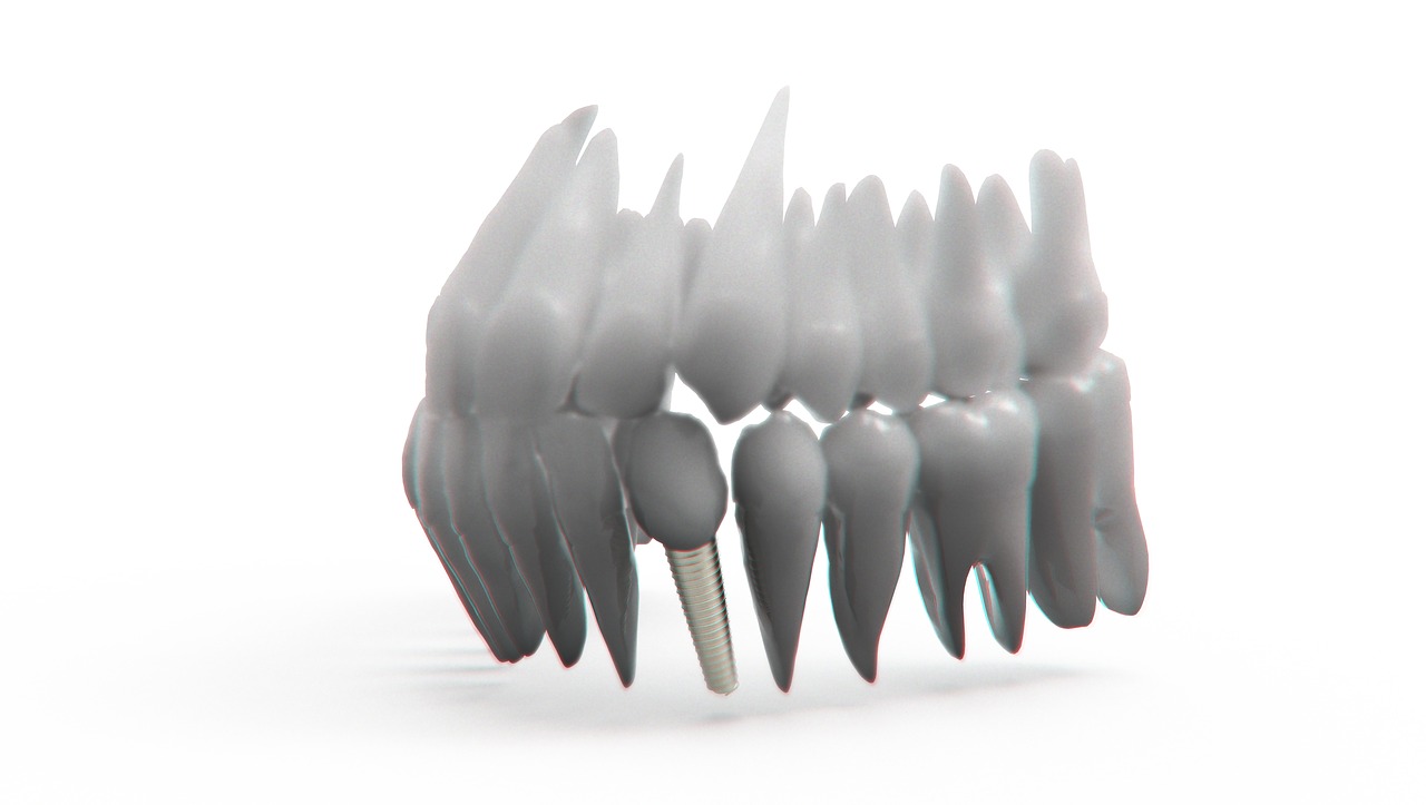 Dantys, Žandikaulis, 3D Modelis, Ortodontija, Implantas, Nemokamos Nuotraukos,  Nemokama Licenzija
