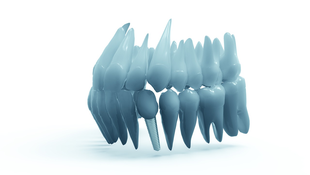 Dantys, Žandikaulis, 3D Modelis, Ortodontija, Implantas, Nemokamos Nuotraukos,  Nemokama Licenzija