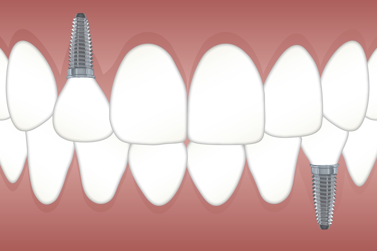 Dantys,  Implantas,  Ortodontija,  Žandikaulio,  Odontologas,  Dantų,  Odontologija,  Klinika,  Operacija,  Sveikata