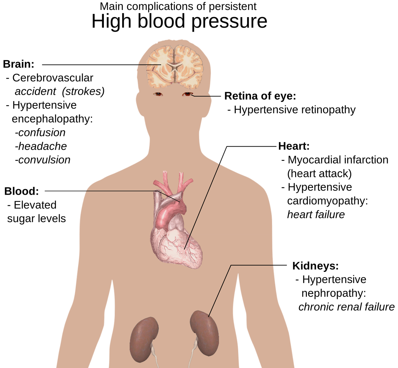 Žmogaus Kūno Anatomija, Didelė Nuotrauka, Hipertenzija, Pagrindinės Komplikacijos, Aukštas Kraujo Spaudimas, Smegenys, Akies Tinklainė, Širdis, Kraujas, Juosmens