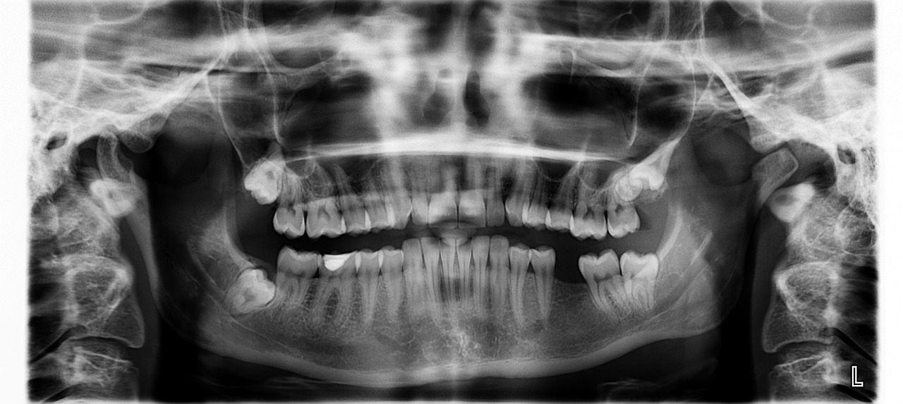 X Ray, Dantys, Trūksta Dantų, Nemokamos Nuotraukos,  Nemokama Licenzija