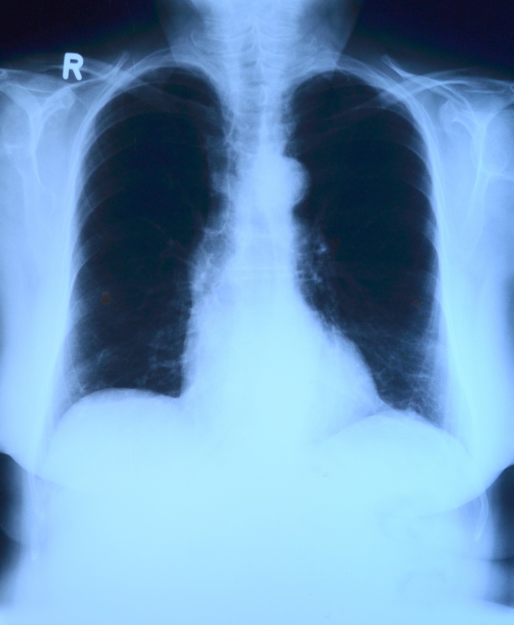 X Ray Image, X Ray, Krūtinės Angina, Plaučių Rentgeno Spinduliai, Medicinos, Nemokamos Nuotraukos,  Nemokama Licenzija