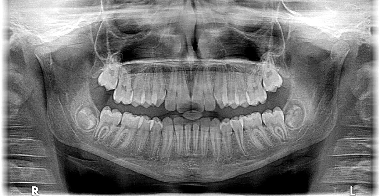 Xray Rentgenas, Rentgeno Spinduliai, Nuotrauka, Rentgenas, Dantys, Žandikaulis, Stomatologas, Ortodontas, Okliuzija, Petnešos