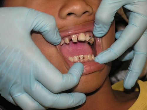 Blogi Dantys, Dantų Skausmas, Dantų Gydymas