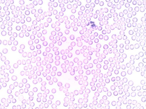 Kraujas, Neutrofilas, Segmentuotas Neutrofilas, Granulocitas, Kraujo Kūneliai, Laboratorija, Mikroskopas, Hematologija, Leukocitų, Baltųjų Kraujo Kūnelių, Eritrocitas, Eritrocitai, Baltieji Kraujo Kūneliai, Raudonasis Kraujo Kūnelis, Raudonieji Kraujo Kūneliai