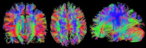 Smegenys, Ponas T, Magnetinio Rezonanso Tomografija, Galva, Traktografija, Nervai, Nervų Pluoštai, Jungtys, Kaukolė, Dti, Tensor, Anatomija