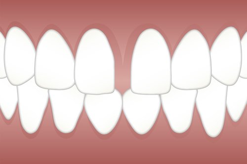 Dantų,  Diastema,  Erdvė,  Gap,  Dantys,  Dantis,  Odontologas,  Sveikata,  Diastema,  Nemokama Iliustracijos