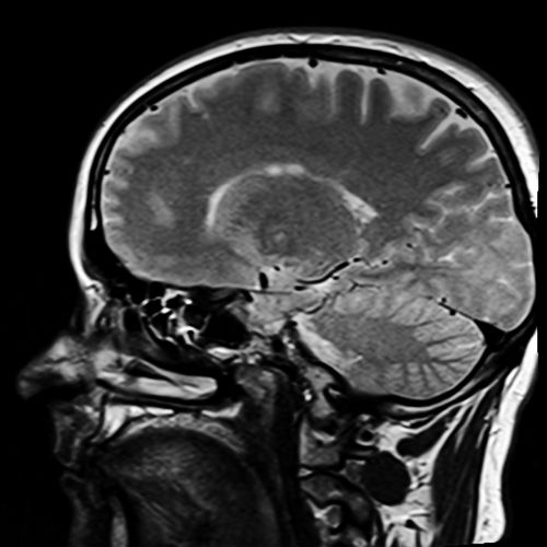 Galva, Magnetinio Rezonanso Tomografija, Ponas T, X Ray, X Ray Image, Smegenys