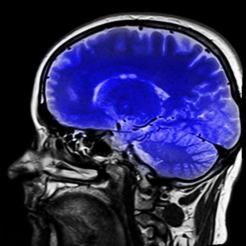 Galva, Magnetinio Rezonanso Tomografija, Ponas T, X Ray, X Ray Image, Smegenys, Mėlynas