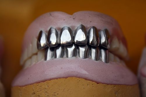 Metaliniai Dantys, Dantų Protezas, Ortodontinis, Burna, Žodžiu