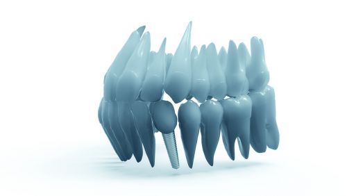 Dantys, Žandikaulis, 3D Modelis, Ortodontija, Implantas