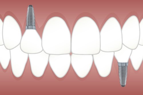 Dantys,  Implantas,  Ortodontija,  Žandikaulio,  Odontologas,  Dantų,  Odontologija,  Klinika,  Operacija,  Sveikata,  Higiena,  Baltos Spalvos,  Dantų,  Dantis,  Chirurgija,  Buveinė,  Implantai,  Nemokama Iliustracijos